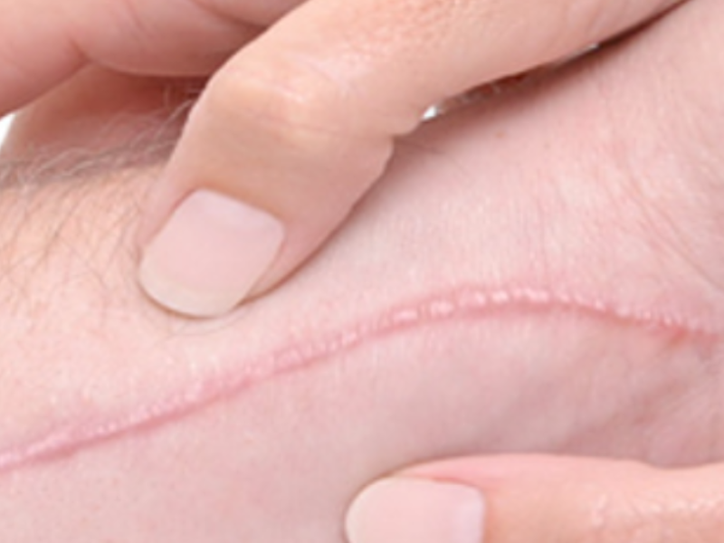 Scar Therapy Massage London Img